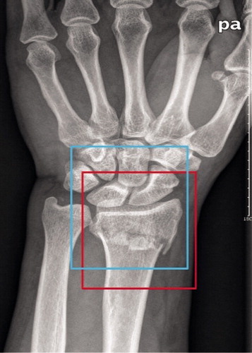 Figure 1. A wrist radiograph was manually annotated with a red rectangle as the ground truth bound and automatically annotated with a blue rectangle as the candidate bound. The red rectangle and blue rectangle represent edges of the region of interest (ROI) detected by the orthopedists and edges of the ROI detected by Faster R-CNN, respectively.