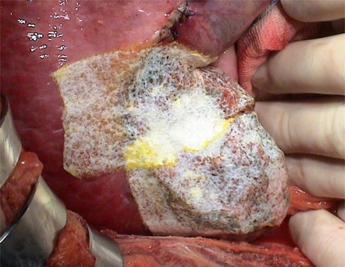 Figure 2 TachoSil correctly placed on the liver surface after hepatic resection.