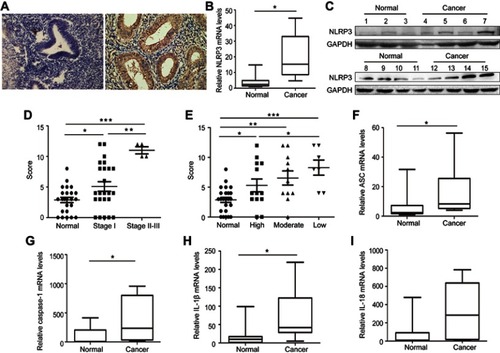 Figure 1 Upregulated NLPR3 inflammasome activation is associated with the progression of human endometrial cancer. (A–C) The expression NLPR3 in 31 endometrial cancer and paired adjacent non-tumor tissues were examined by immunohistochemistry, quantitative PCR, and Western blot. (D–E) Stratification analysis of the association of NLRP3 expression with cancer stage and grade. (F–I) Quantitative PCR analysis of ASC, caspase-1, IL-1β, and IL-18 mRNA levels in endometrial cancer and adjacent non-tumor endometrial tissues. Data are representative images or expressed as individual values or median ±75% percentile (magnification ×400). *P<0.05, **P<0.01, ***P<0.001.