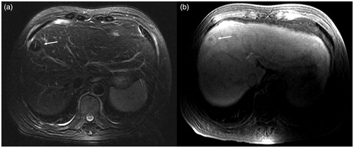 Figure 4. Scan after ablation: TSE fs T2WI (a) shows hypointensity at the ablation lesion. The central microwave antenna needle shows a strip-like hyperintensity (white arrow), and a thin layer of higher signal ring is visible in the periphery of the ablation lesion. In the 3D Dyn T1WI sequence (b), the ablation lesions show a ‘target sign’. The central lesions are still hypointense, and the surrounding ablation area shows hyperintensity, but there is no obvious difference between the high signal intensity ablation lesion and the higher signal intensity of normal liver parenchyma in the hepatobiliary phase.