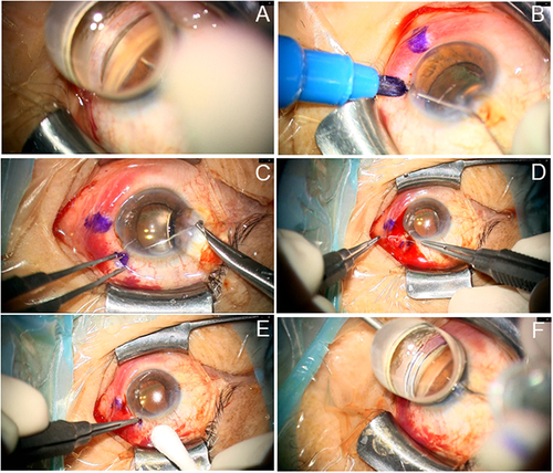 Figure 3 Continuous still images from the intraoperative video of minimally invasive direct internal cyclopexy being performed in case 2. (A and B) Confirmation and marking of the extent of cyclodialysis. (C) Intraocular insertion of PC-9 double needles into the ciliary sulcus at the site of cyclodialysis. (D) Mattress suture at the cyclodialysis site (internal direct cyclopexy). (E) Subconjunctival implantation of the knot. (F) Confirmation of the repair of cyclodialysis.