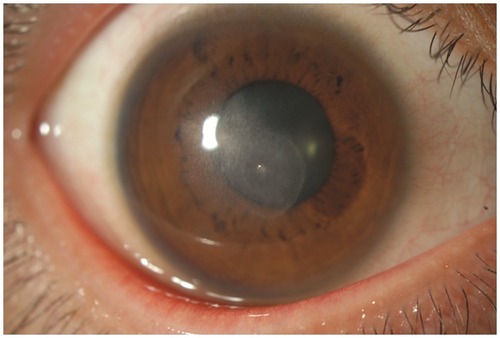 Figure 5 Even though the therapeutic intervention finally cured the inflammation, corneal opacity remained at the original site of the infection.