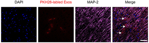 Figure 4 Co-localization of PKH26-labeled NSC-Exos and MAP-2 positive cells in parietal cortex. Red fluorescence indicates PKH26-labeled exosomes, pink fluorescence indicates MAP-2 positive neurons and blue fluorescence indicates nuclei. Labeled exosomes were localized in the cytoplasm of MAP-2 positive cells, indicating that exosomes were successfully taken up by neuronal cells (The white arrow indicates the co-localized expression of PKH26 and MAP-2 positive cells, Scale bar=20μm).