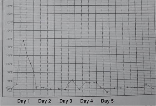 Figure 2. Nursing chart showing rapid clearance of fever after initiation of liposomal amphotericin B treatment in a patient with visceral leishmaniasis at Vaishali District Hospital, Bihar State, India.