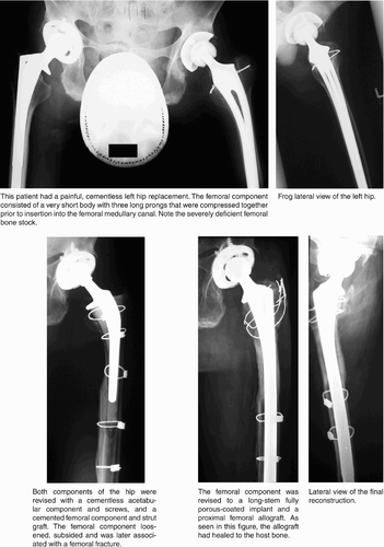 Figure 3. Case 1. Painful total hip replacement in a patient with ankylosing spondylitis.