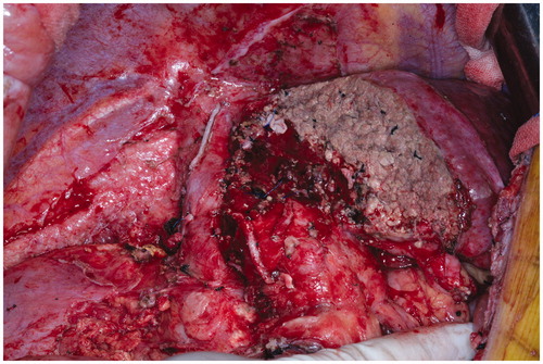 Figure 3. During stage II of RALPPS, the peritoneal inflammatory response decreased and adhesions were few because the liver was not mobilised in stage I.