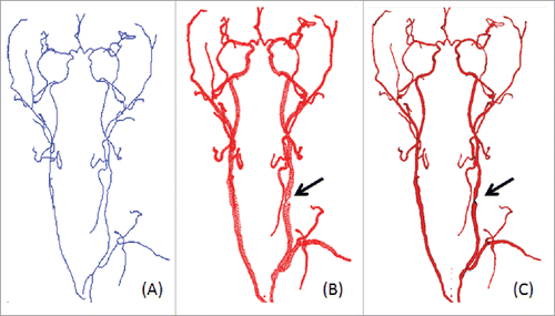 Figure 5. A clinical case of reconstructed vascular stenosis. (A) Estimated vascular centerline, (B) the generated bash mesh and (C) vascular reconstruction with Loop subdivision.