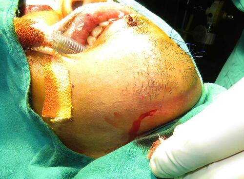 Figure 1 Incision made at submental region after orotracheal intubation.