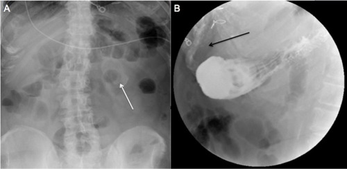 Figure 3 Initial scout films demonstrated a large 5–6 cm gallstone projecting over the left upper quadrant (white arrow; A). Upper gastrointestinal series demonstrated contrast extravasation (black arrow) into the right upper quadrant suspected to be into a contracted gallbladder and consistent with a cholecystogastric fistula (B).