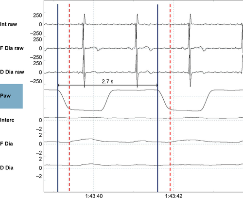 Figure S3 A pressure-controlled (PC) breath.Notes: Shown are (from top to bottom) the raw intercostal signal (Int raw), the raw frontal diaphragm signal (F Dia raw), the raw dorsal diaphragm signal (D Dia raw), the pressure wave (Paw), the average intercostal signal (Interc), the average frontal diaphragm (F Dia) signal, and the average dorsal diaphragm signal (D Dia). Two PC breaths are shown, electromyography activity (the dotted red line) appears but after the pressure wave (the straight blue line) started. This is a tracing during a high-pressure, high-frequency setting, with a backup frequency of 22 breaths/min, so that an in-between breath time of 2.7 s means that the ventilator delivers a breath at the moment it is supposed to do according to the set-up backup frequency. Of note, electromyography activity was much lower with this setting.