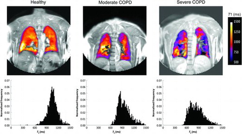 Figure 1.  Representative coronal lung MRI T1 maps overlaid on a signal intensity image with corresponding normalised T1 histograms for healthy, moderate COPD and severe COPD subjects. Both T1 maps and histograms reflected the severity of COPD by reduced T1 and increased heterogeneity.