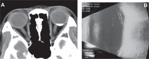 Figure 2 (A) Computed tomographic images of patient with choroidal osteoma, showing calcification and bone-density mass in the posterior pole of the left eye. (B) Ultrasonic echography (B-mode) shows a convex elevation in the posterior pole of the eye, producing an acoustic shadow behind the sclera.