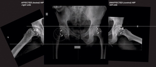 Figure 1. Anteroposterior and axial radiograms of the patient after right-sided LCPD with obvious flattening of the articular surface in the anteroposterior direction; r represents the radius of the contour of the articular surface in the frontal plane, and r−δ represents the semiaxis of the elliptical contour in the sagittal plane. The axial radiograms were rotated to the extent that the vertical semiaxis of the ellipse in the sagittal plane (r, r−δ) was parallel to the horizontal semiaxis of the circle in the frontal plane.