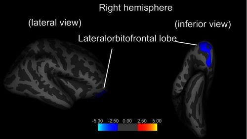 Figure 2 Genotype × diagnosis interaction on cortical thickness. The blue cluster represents the genotype × diagnosis interaction effect on the cortical thickness of the right-lateral orbitofrontal lobe) (FWE corrected P<0.05).