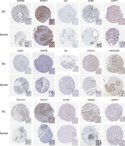 Figure 7 Representative immunohistochemistry of 15 LMGs between breast cancer and normal tissues in the Human Protein Atlas database.