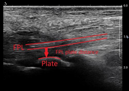 Figure 1 FPL plate distance. It is defined as the distance between the distal edge of the plate and the FPL tendon.