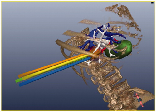 Figure 5. The pre-operative manual planning is achieved through 3D visualisation of the pre-operative planning system, and four MW antennas are needed to ablate the tumour completely.