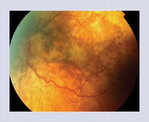 Figure 6. Fundus photograph of the left eye of a patient with chronic convalescent Vogt–Koyanagi–Harada disease shows sunset glow fundus with retinal pigment epithelium migration/clumping and subretinal fibrosis in the posterior pole.