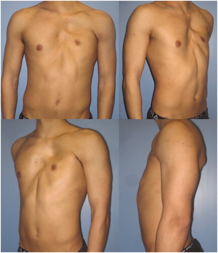 Figure 1. Pre-operative photographs of the 23-year-old patient, in the frontal (upper left), right oblique (upper right), left oblique (lower left) and lateral (lower right) projections.