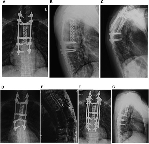 Figure 3 Typical case 2: internal fixation failure occurred in a 32-year-old male patients 47 months after T3-5 invasive osteoblastoma operation. (A and B) The positive and lateral X-ray internal fixation was good before the rods are broken. (C and D) The positive and lateral X-ray of the broken rods. (E) No tumor recurrence found on T2-weighted MRI of the lumbar vertebrae. (F and G) The positive and lateral X-ray film after revision, fixed with double rods during the operation. Simultaneously, a pair of pedicle screws were added to the seventh cervical vertebra for fixation.