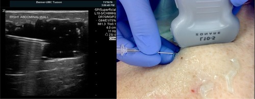 Figure 2 Ultrasound image demonstrating needle drainage technique.