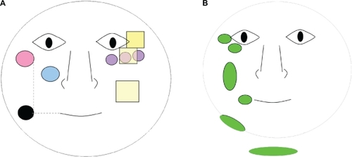 Figure 1 Schematic representation of the assessment areas (on the left for biometrologic assessments and stripping, on the right for clinical scoring). Each assessment was performed on both sides of the face A) left; B) right.Key: Display full size Cutometer®; Display full size D-Squame® tape strips; • Corneometer® Aquaflux®; Display full size Spectrophotometer (three measures across the cheekbone); Display full size Fringe projection (roughness + wrinkle volume); Display full size Clinical scores.