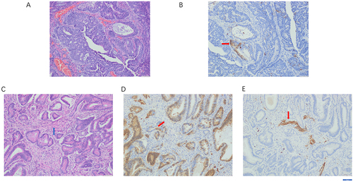 Figure 7 Immunohistochemical detection of neural proliferation differentiation and control-1 (NPDC1) in colon cancer tissues. (A) Representative example of Hematoxylin and eosin (H&E) staining of perineural invasion (PNI)-negative cancer tissue; (B) Representative examples of NPDC1 immunohistochemistry in PNI-negative cancer tissues, with red arrows pointing to NPDC1 expression; (C) Representative examples of H&E staining in PNI-positive cancer tissues, with blue arrows pointing to tumor cells encircling the nerves; (D) Representative examples of NPDC1 immunohistochemistry in PNI-positive cancer tissues, with red arrows pointing to nerve tissue; (E) S-100 staining of nerve tissue infiltrating into the interior of the tumor, with red arrows pointing to nerve tissue. Scale bars = 50 μm.