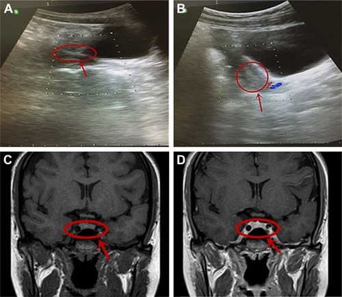 Figure 1 Abdominal ultrasound examination and head MRI examination were performed on this patient.
