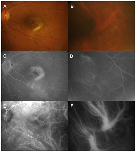 Figure 3 Fundus findings after three intravitreal ranibizumab injections. Fundus photographs (A) and (B) show disappearance of subretinal hemorrhage. No choroidal neovascularization and subretinal hemorrhage in the corresponding area are seen on fluorescein angiography (D) and indocyanine green angiography (F). However, there are some choroidal neovascularizations (arrows) in the posterior pole of the left eye (C) and (E).