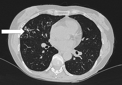 Figure 2. Radiographic presentation of the nodular-bronchiectatic form of NTMPD. Peripheral nodules and bronchiectasis (arrow) in the lower lung areas. HRCT image kindly provided by Dr L. Codecasa.
