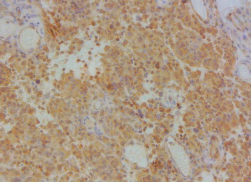 Figure 7. The brown–yellow granules of the cell membrane and cytoplasm of vascular endothelial cells showed a positive VEGFR2 (×200).