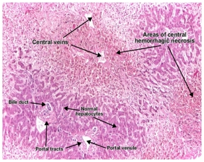 Figure 1 Areas of central hemorrhagic necrosis in the liver.