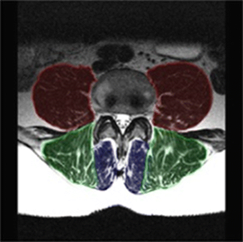 Figure 2 Sample MR slice at L4 with bulk muscle boundaries highlighted. The highlighted muscles include the bilaterally occurring: psoas (bilateral to the vertebral body), erector spinae (posterior to psoas muscles) and multifidi (bilateral to the spinous process and posterior to the transverse processes). (Note: The image has been brightened and contrasted to enhance relevant tissue boundaries).