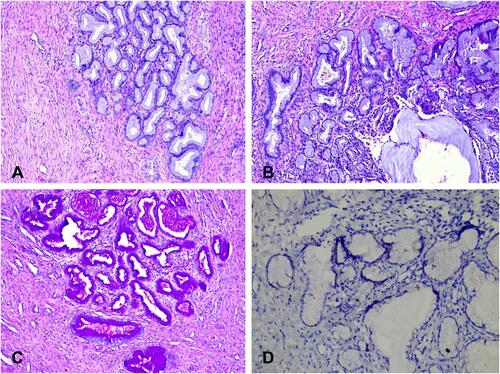 Figure 5 Histology of lobular endocervical glandular hyperplasia. (A) – Lobular endocervical glandular hyperplasia (HE x100). (B) – Glandular hyperplasia with lobular/acinar architecture composed of a central gland with cystic dilation, surrounded by smaller glands and cysts arranged in a floret-like pattern (HE x200).(C) – Lobular endocervical glandular hyperplasia (PAS reaction x100). PAS+ neutral mucin is observed in the cytoplasm of glandular cells. (D) – Lobular endocervical glandular hyperplasia (IHC-CEA x200).