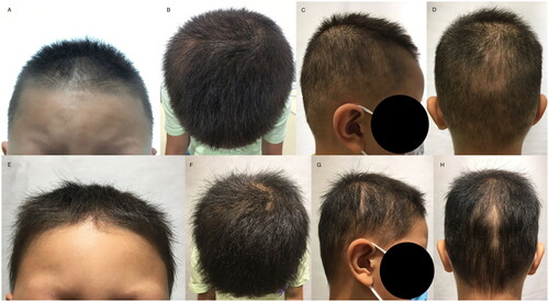 Figure 1. Naked eye view before treatment (A–D); naked eye view one month after treatment (E–H).