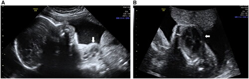 Figure 2. #Case 2. Two-dimensional ultrasound in the sagittal (A) and four-chamber (B) views showing the partial ectopia cordis (arrow) at 29 weeks of gestation.