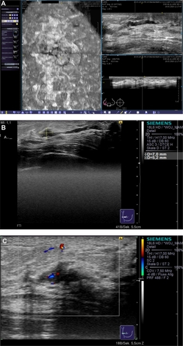 Figure 10 Clinical example of a patient with nipple discharge. The duct ectasia can be seen in the reconstructed coronal plane (A, left), and an intraductal lesion was suspected in the transverse (A, upper right) and sagittal planes (A, lower right). Conventional ultrasound (B) confirmed the diagnostic findings of a vasculated (C) papillary lesion.