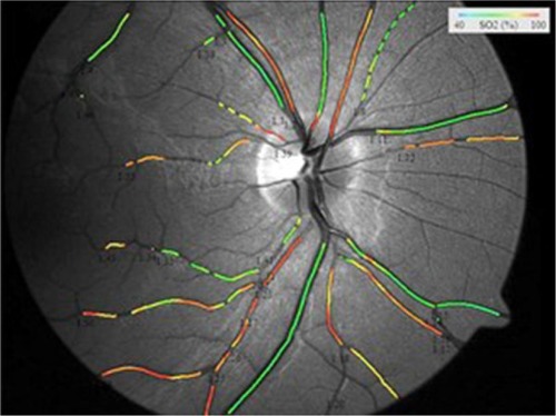 Figure 2 Image from the Vesselmap system showing oxygen saturation in the retinal vessels.