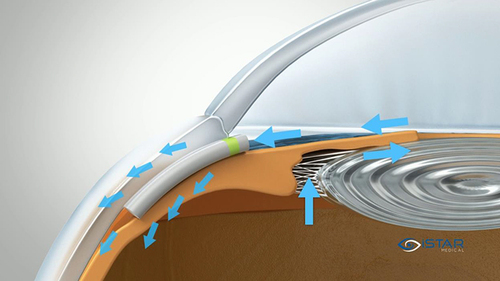 Figure 1 Schematic of the device in situ. © iSTAR Medical.