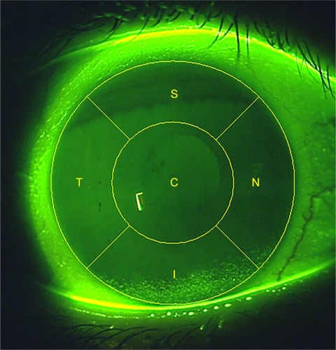 Figure 1 Schematic illustrating the five corneal zones.