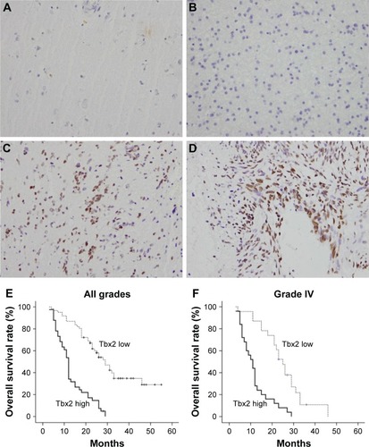 Figure 1 Expression pattern of Tbx2 in human astrocytoma.