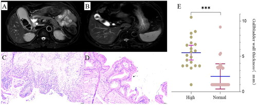 Figure 2. Morphology of gallbladder under MRI and HE staining. A ∼ B Cross-section view of gallbladder in high group and normal group under MRI. C ∼ D Gallbladder mucosa morphology of high group and normal group under HE staining (Scale bars = 50 μm). E Gallbladder wall thickness in the high group and normal group (Measured by Carestream on MRI). A and C, B and D are the same patients, respectively. P-value is determined by t-test. *** p < 0.001.