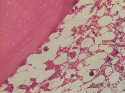Figure 1. Histological features of osteonecrosis in rabbits treated with 20 mg/kg methylprednisolone acetate and cyclosporin A. The bone trabeculae show empty lacunae. The surrounding bone marrow tissue consists of necrotic bone marrow cell debris (Hematoxylin and eosin; magnification: ×200).