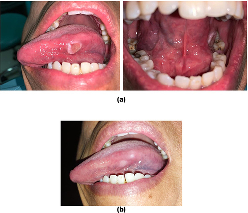 Figure 2 (a) Traumatic ulcer on lateral left of the tongue. There were 36 retained roots located next to the ulcer. (b) Two weeks after first visit, the lesion healed.