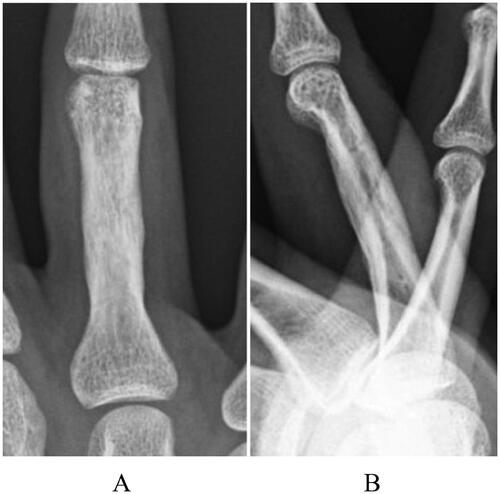 Figure 6. A 10-month postoperative radiograph of case 2, showing complete union without reduction loss: (A) antero-posterior view and (B) later al view.