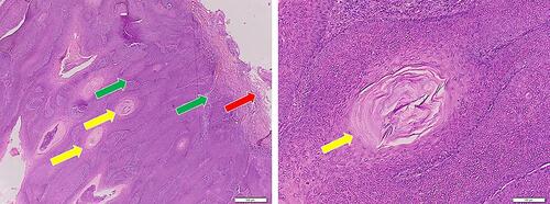 Figure 2 Histopathological appearance of the case. The histopathological features of the skin lesion, hyperkeratosis (red arrow), acanthosis, hyperplasia, and papillomatosis (green arrow), along with intercellular pseudo-horn cyst (yellow arrow), which support the diagnosis of SK.