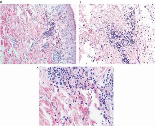 Figure 3. Skin biopsy from the buttock demonstrates that eosinophilic predominant infiltrates comprised of perivascular inflammatory cuffs with a lymphohistiocytic component in addition to numerous eosinophils with diffuse interstitial eosinophilic infiltrates in the mid and lower dermis (4 x) (a). (b) 10x. (c) 40x