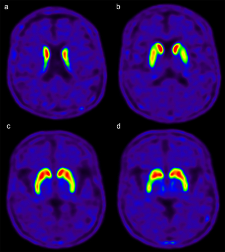 Figure 2. (a-d) 18 F-FP-CIT PET/CT imaging. 18 F-FP-CIT demonstrated decreased uptake in bilateral posterior putamen, especially on the left side.