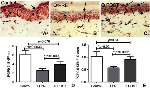 Figure 2 Immunohistochemistry in skin biopsies for PGP9.5, before and after capsaicin 8% patch treatment. Intra-epidermal nerve fibers (arrowed) and sub-epidermal nerve fibers from (A) control subjects, at the baseline visit (B, Q PRE) and, after capsaicin 8% patch treatment (C, Q POST), magnification x40. (D) Bar chart of intra-epidermal nerve fibers for PGP 9.5 counts, (E) bar chart of sub-epidermal (SENF) analysis (% area).Notes: *Significant; **very significant.