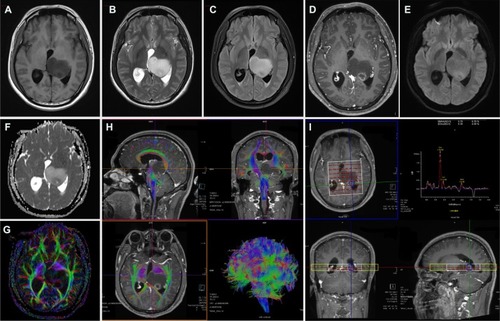 Figure 1 Brain MRI for the case. Conventional MRI sequences (A) T1WI, (B) T2WI, and (C) T2 FLAIR, left thalamic mass showed long T1, long T2, and higher T2-FLAIR signals, respectively; (D) contrast-enhanced T1WI sequence, small focal ring enhancement in the posterior part of the mass, no enhancement in the rest of the mass; (E) diffusion weighted imaging (DWI), b=1,000, a slightly higher ring signal in the dorsal mass; (F) ADC shows a slightly lower ring in the posterior mass, suggesting limited water diffusion; (G) A DTI sequence, FA map suggests that the left thalamic FA is significantly reduced compared with the contralateral side; (H) DTI fiber tractography, white matter fiber in the left thalamic lesion were destructed or partial displacement; (I) MRS, left thalamic lesion enhancement area ROI metabolite spectrum, Cho increased significantly, NAA decreased significantly, Cho/NAA ratio of 8.09, and inverted lactate peak. The postoperative pathology confirmed the anaplastic astrocytoma (WHO grade III).